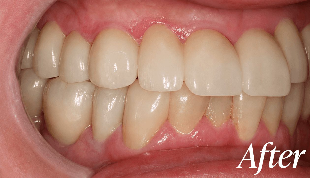 After dental implant treatment