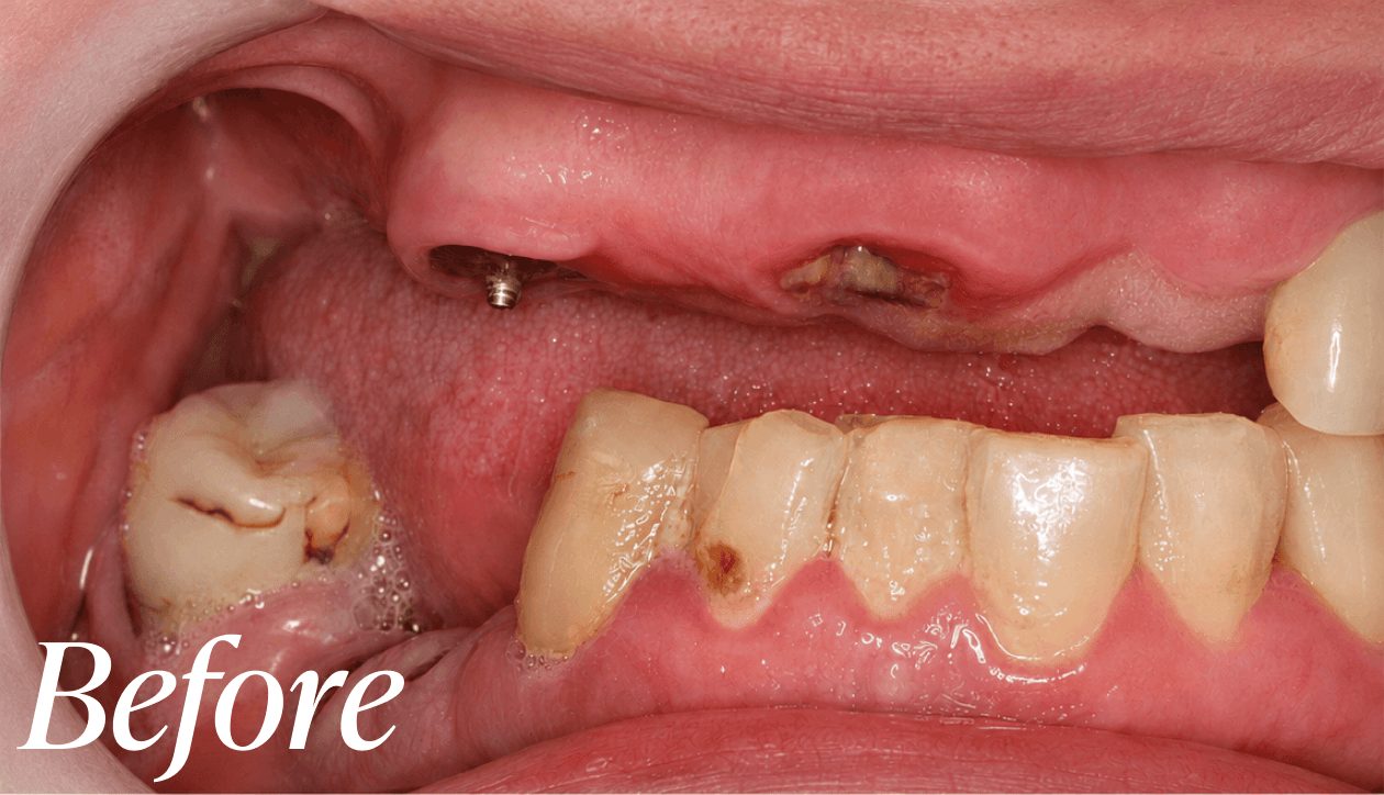 Before dental implant treatment
