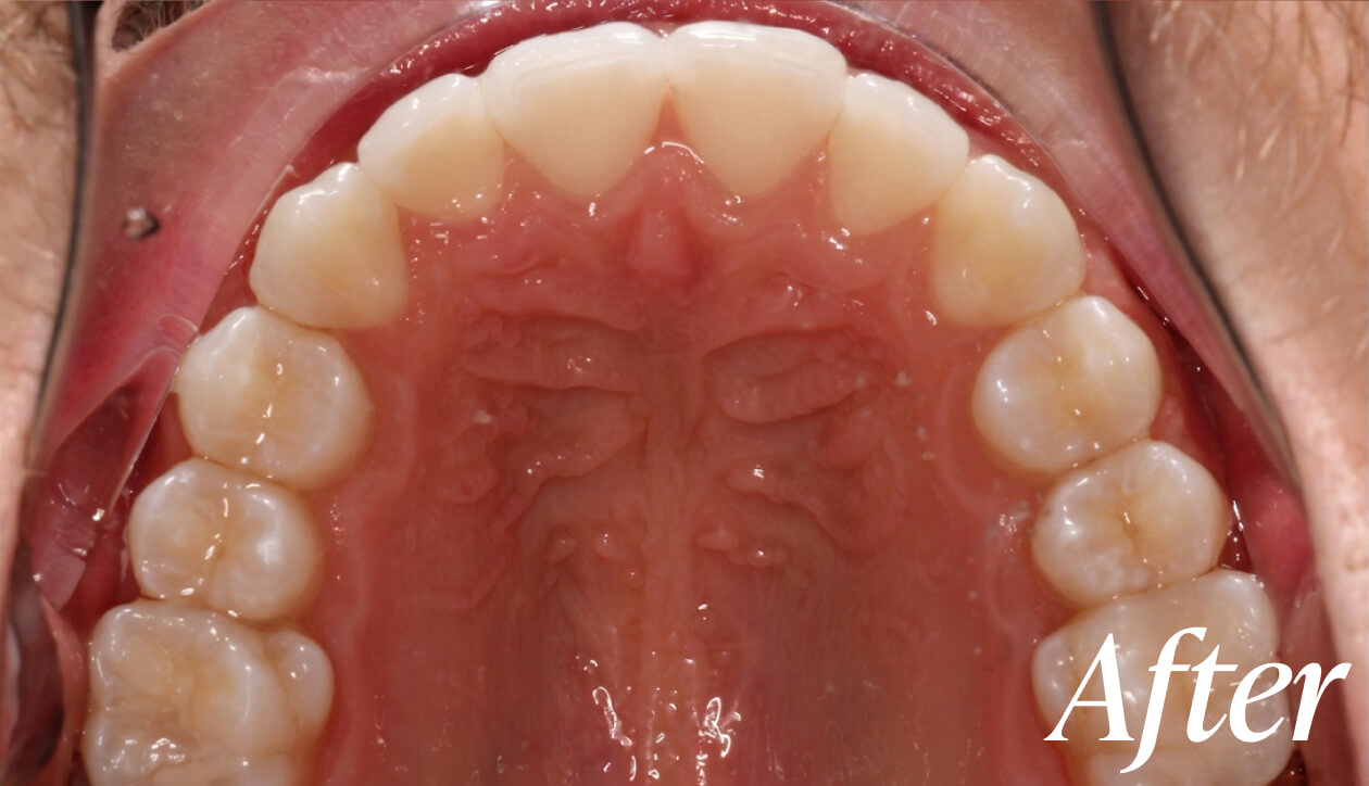 After dental implant treatment