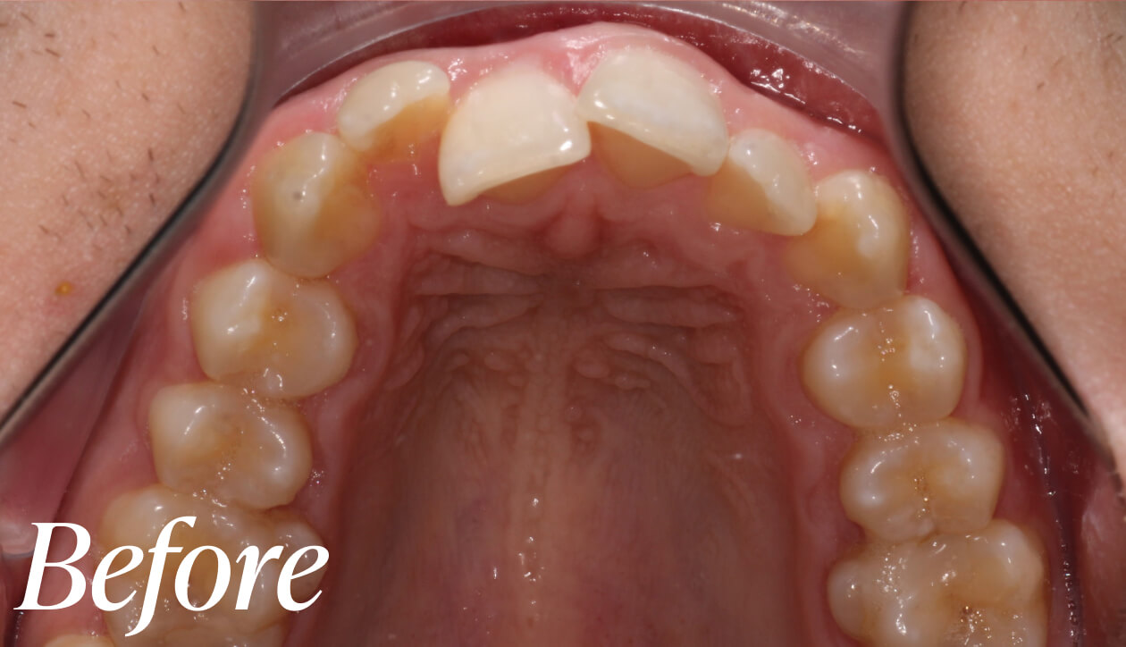 Before dental implant treatment