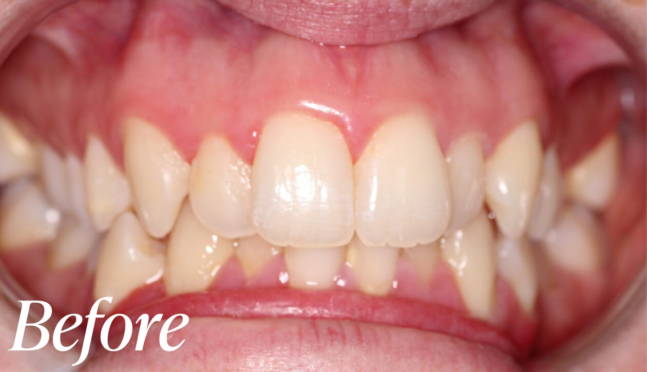 Before dental implant treatment
