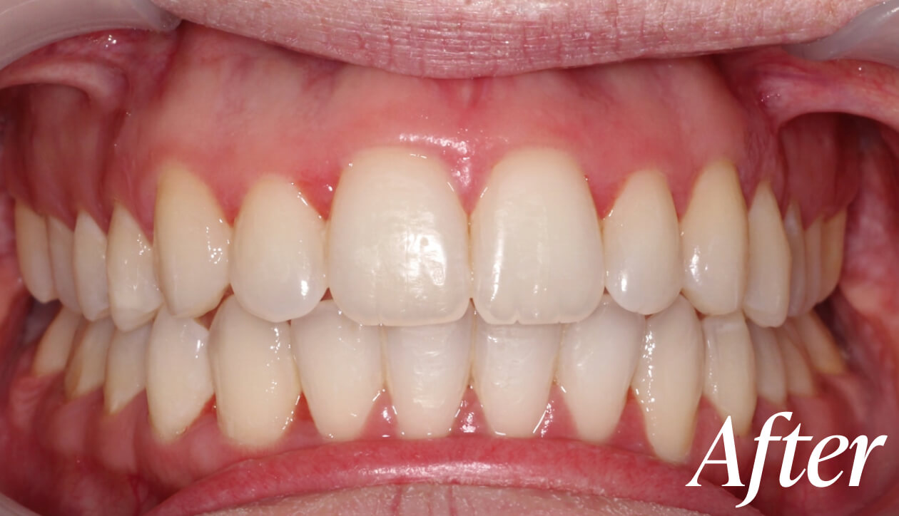 After dental implant treatment
