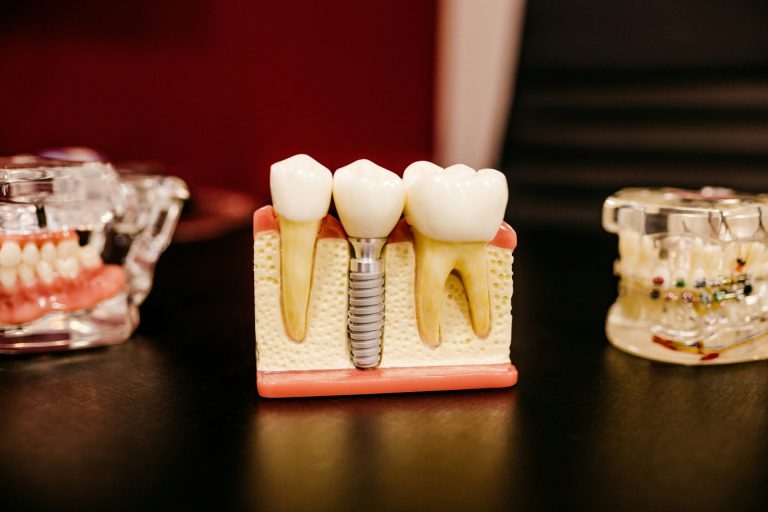 average cost of dental implants