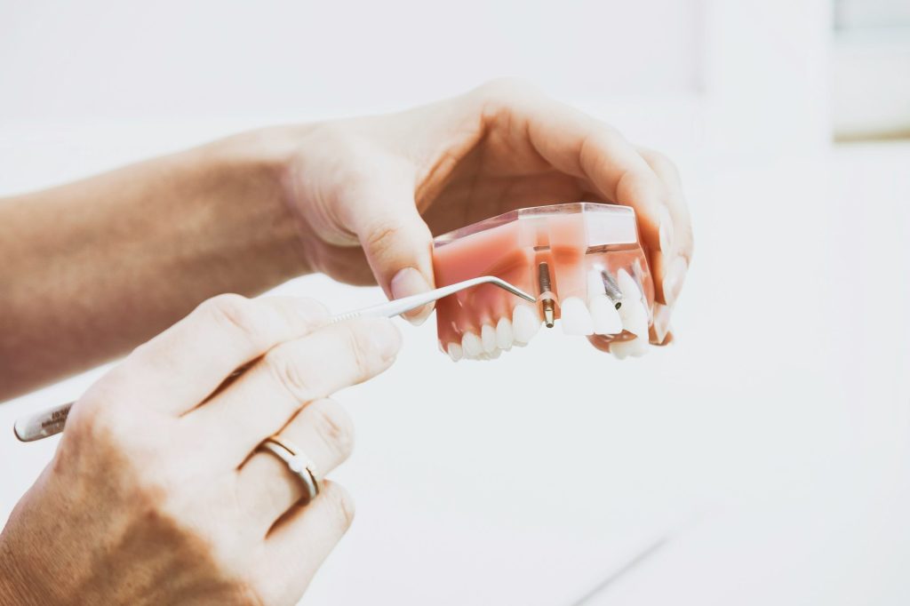 All-on-4 Dental Implants